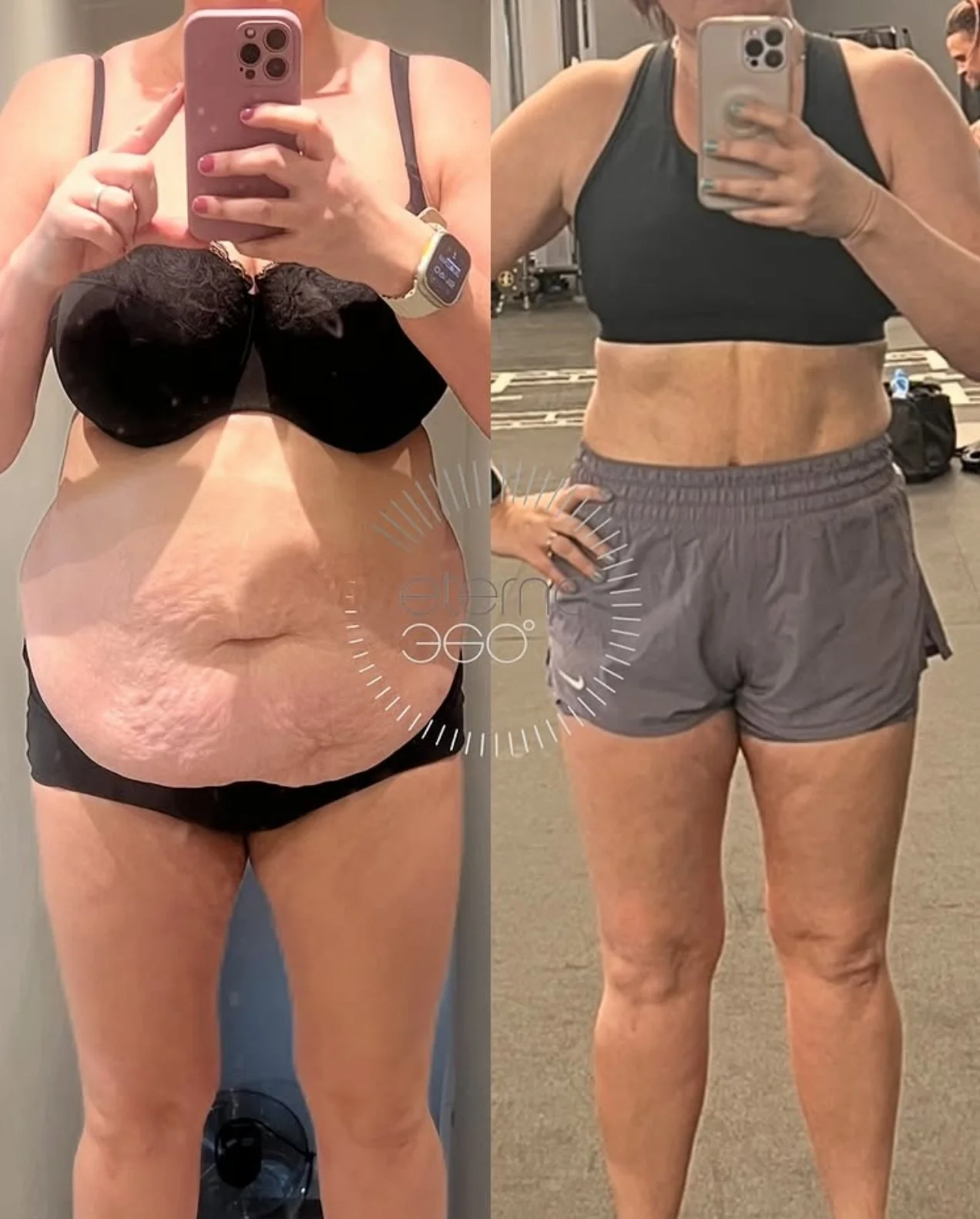 Understanding the Challenge: Tummy Overhang and Stubborn Fat