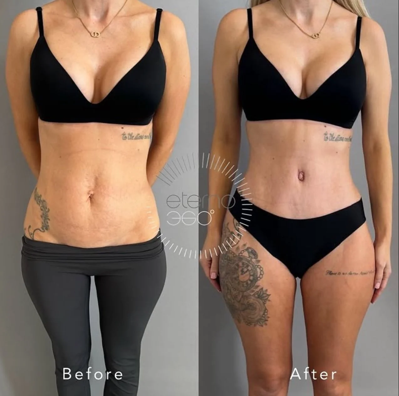 Embracing Confidence After Pregnancy: How Lipoabdominoplasty Can Help Restore Your Waistline