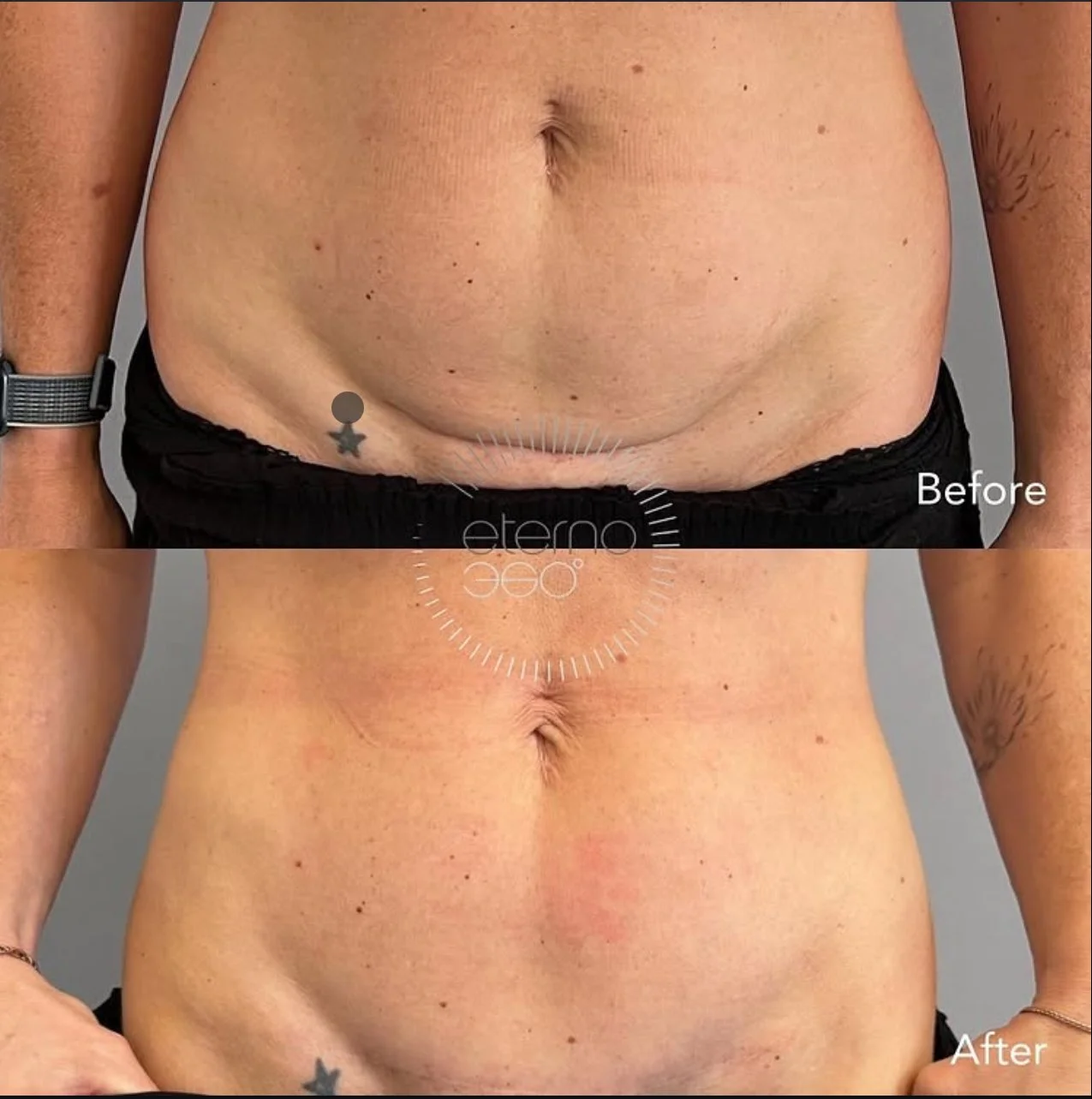 Understanding Caesarean Section Scars: What You Can Do About Them