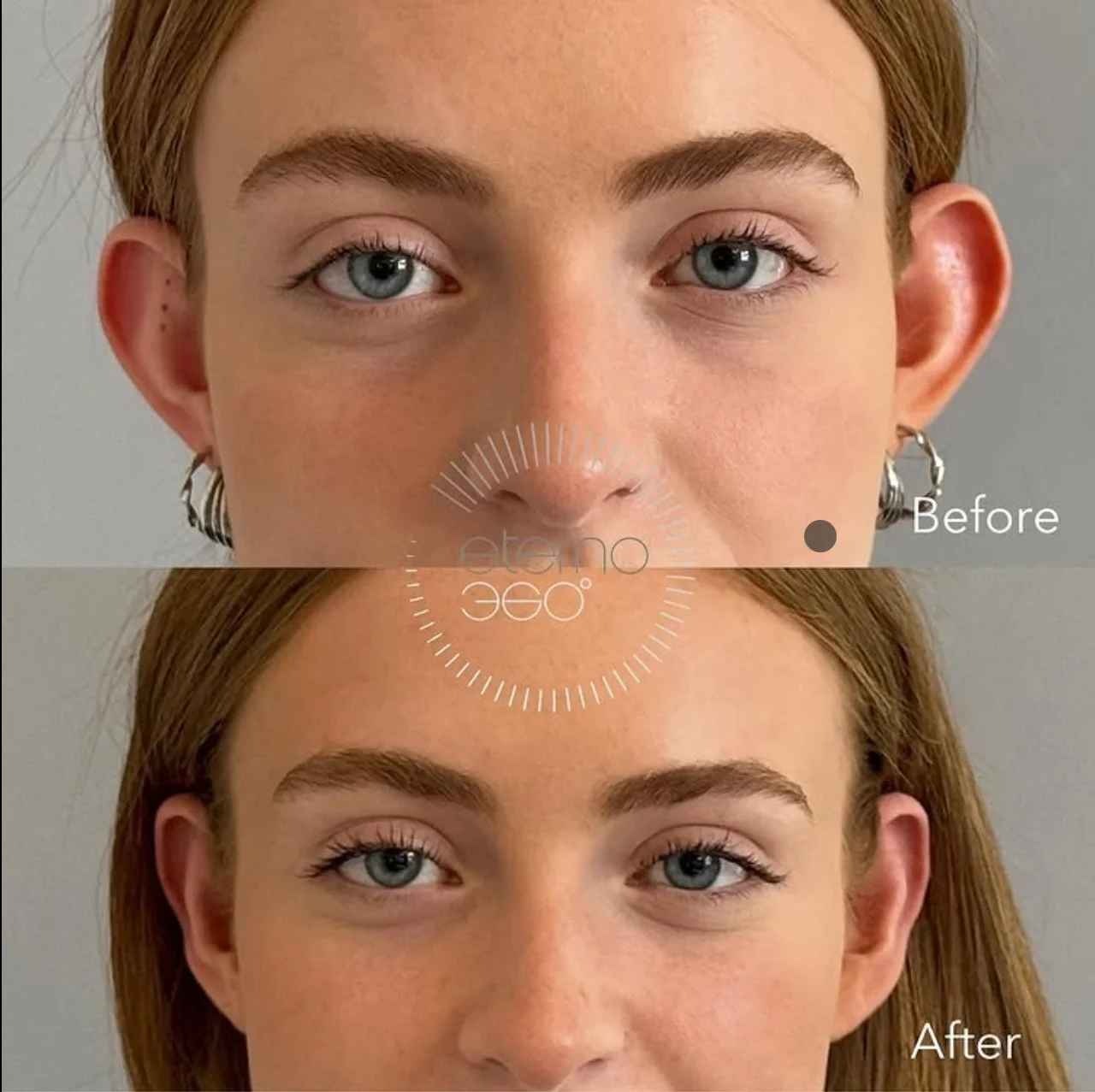 Prominent Ear Correction: A Modern, Simple Solution to a Common Confidence Concern