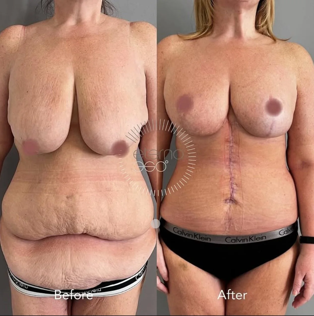 Navigating Post-Massive Weight Loss Surgery: One Patient’s Inspiring Journey and What You Need to Know
