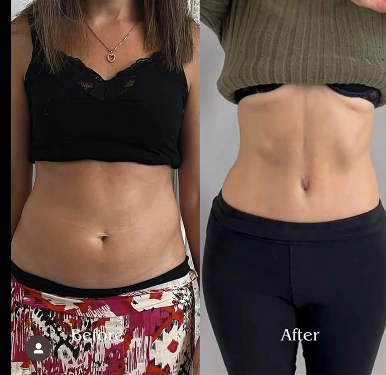 A Comprehensive Guide to Body Contouring Treatments: What You Need to Know