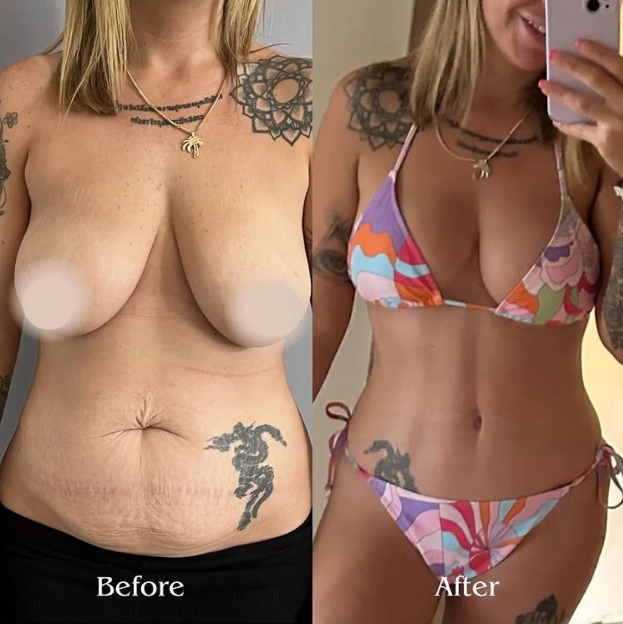Breast Lift (Mastopexy) and Lipoabdominoplasty: Are These Body-Contouring Procedures Right for You?
