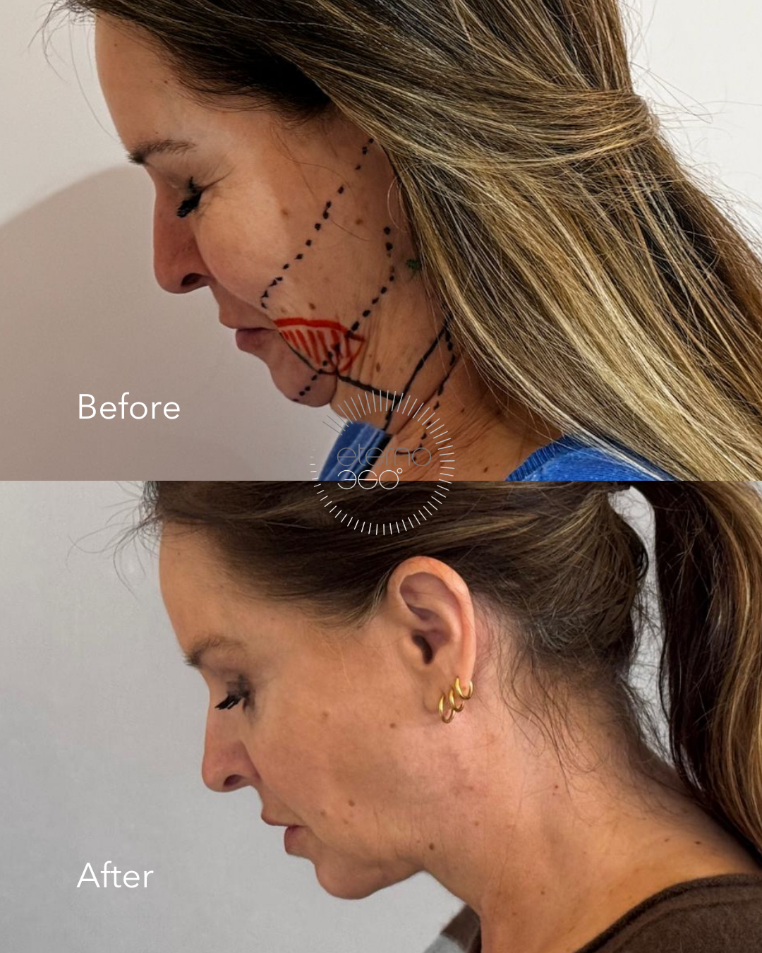 Liposuction to Chin .png