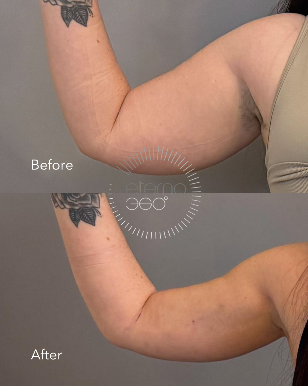 Arm Lift - Consented.png