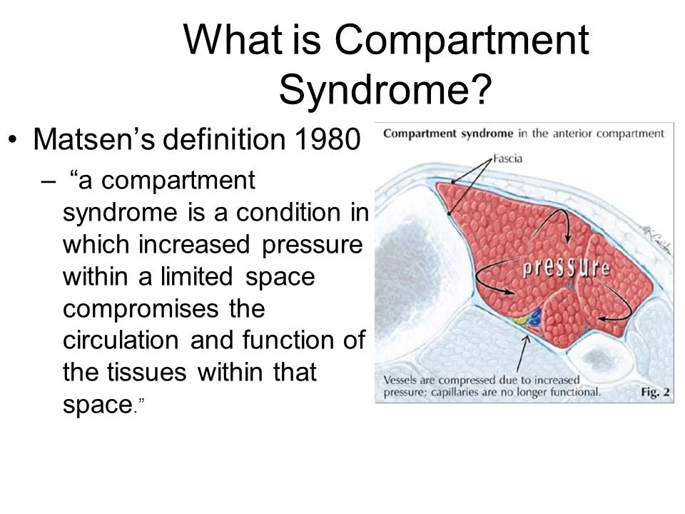 Delayed diagnosis of compartment syndrome is a major cause of amputation.