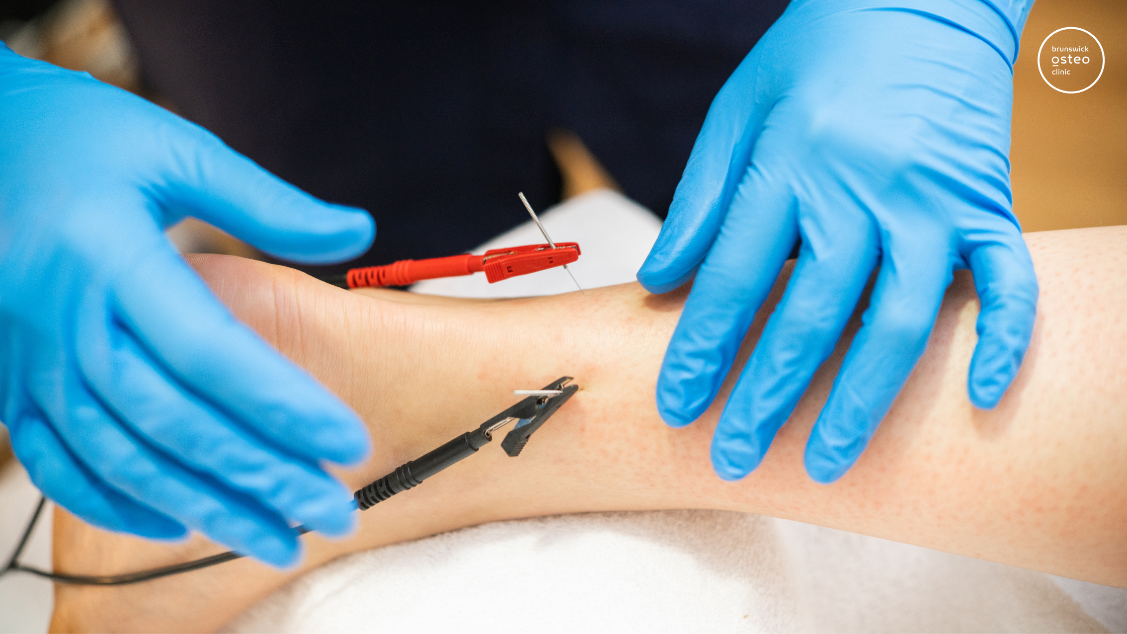 Electrotherapy with dry needling