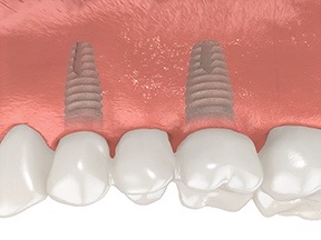 BRIDGE OVER IMPLANTS