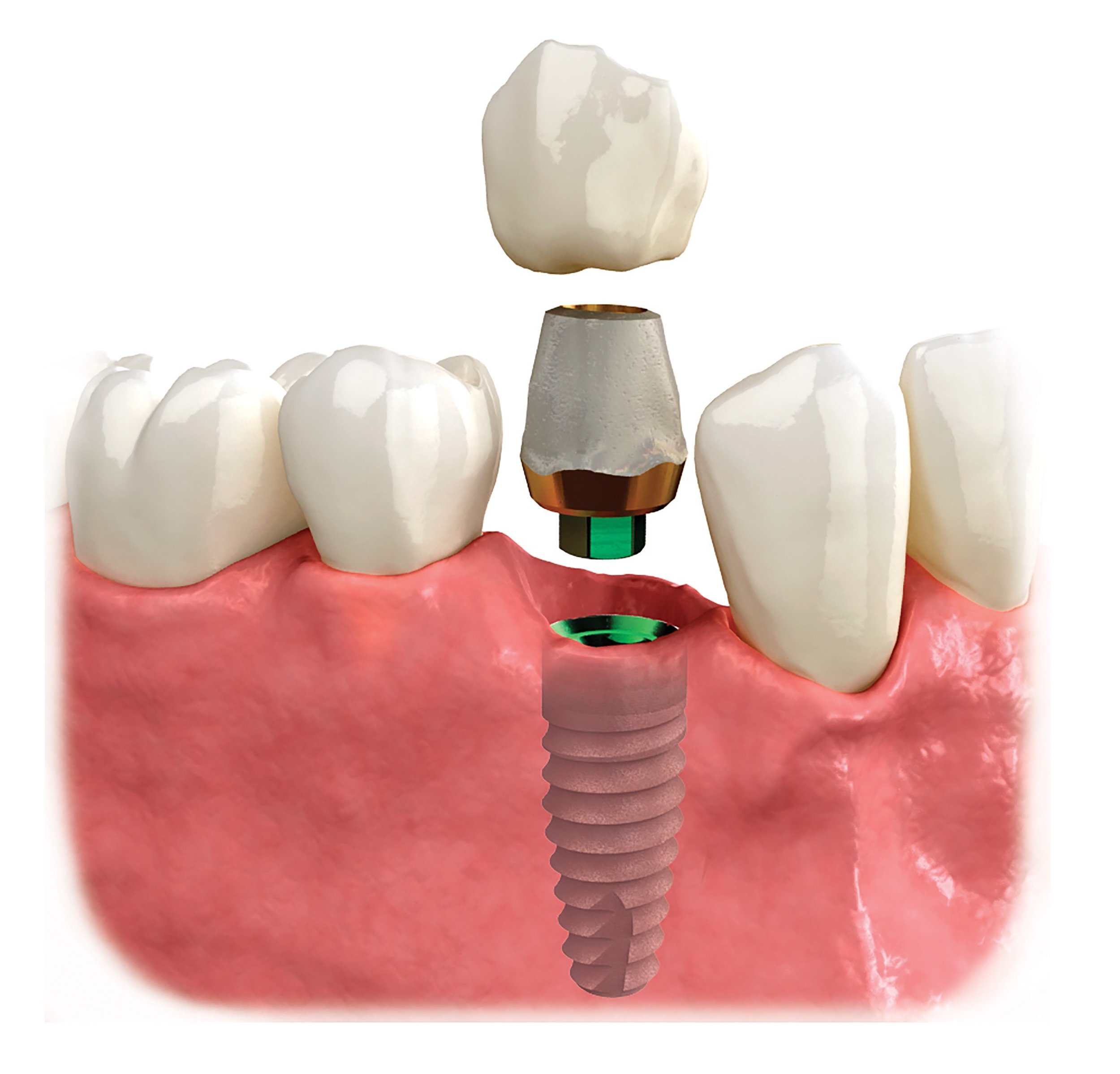 TOOTH IMPLANT