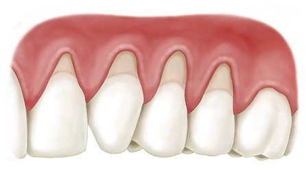 GUM RECESSION PRE-OP