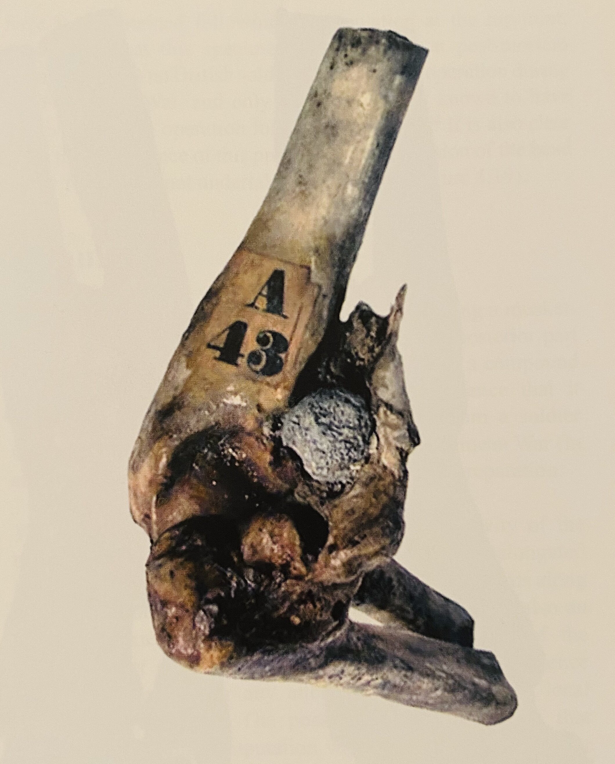 Fig.4 Musket-ball in elbow joint