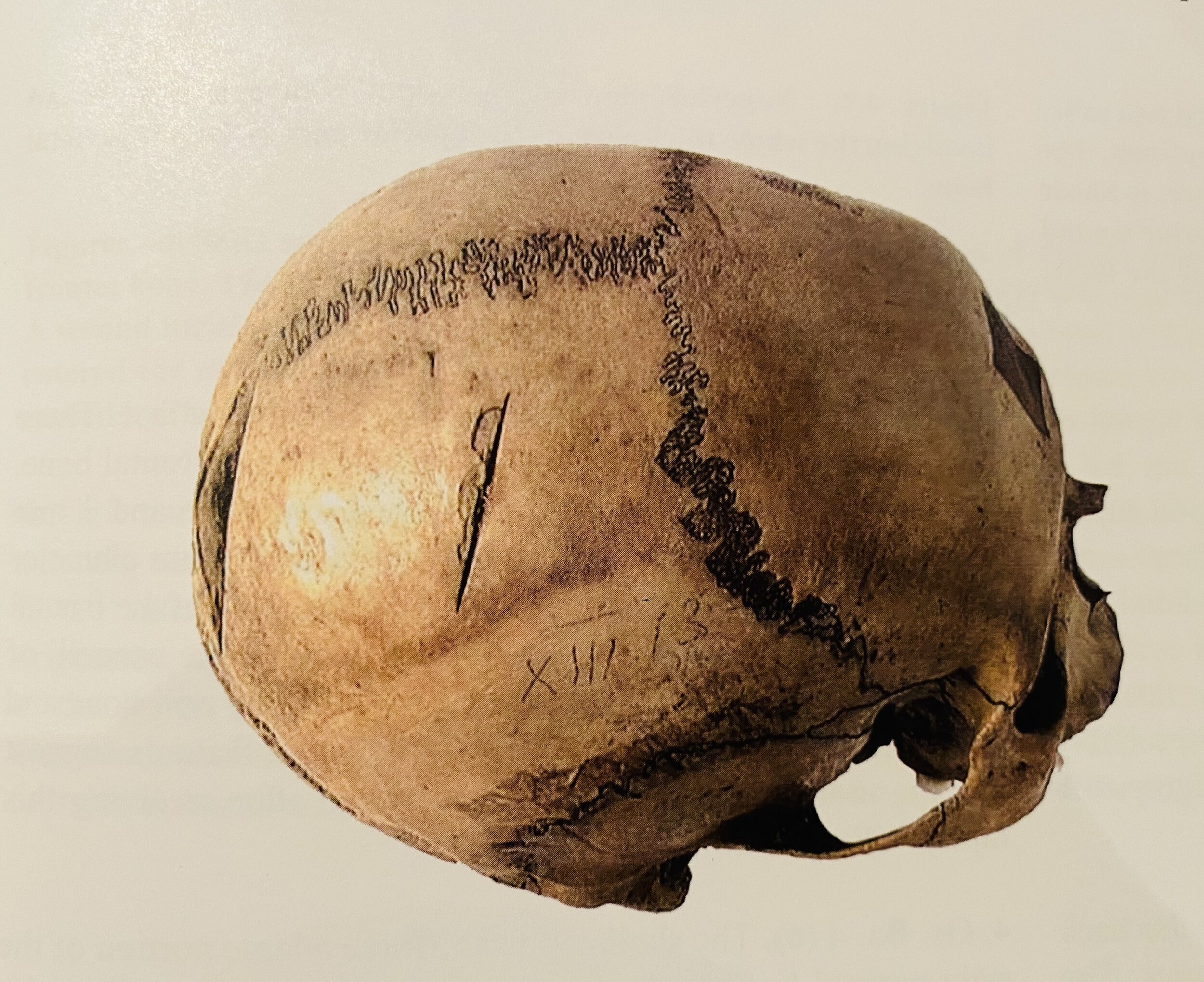 Fig. 5 Sabre cuts to skull