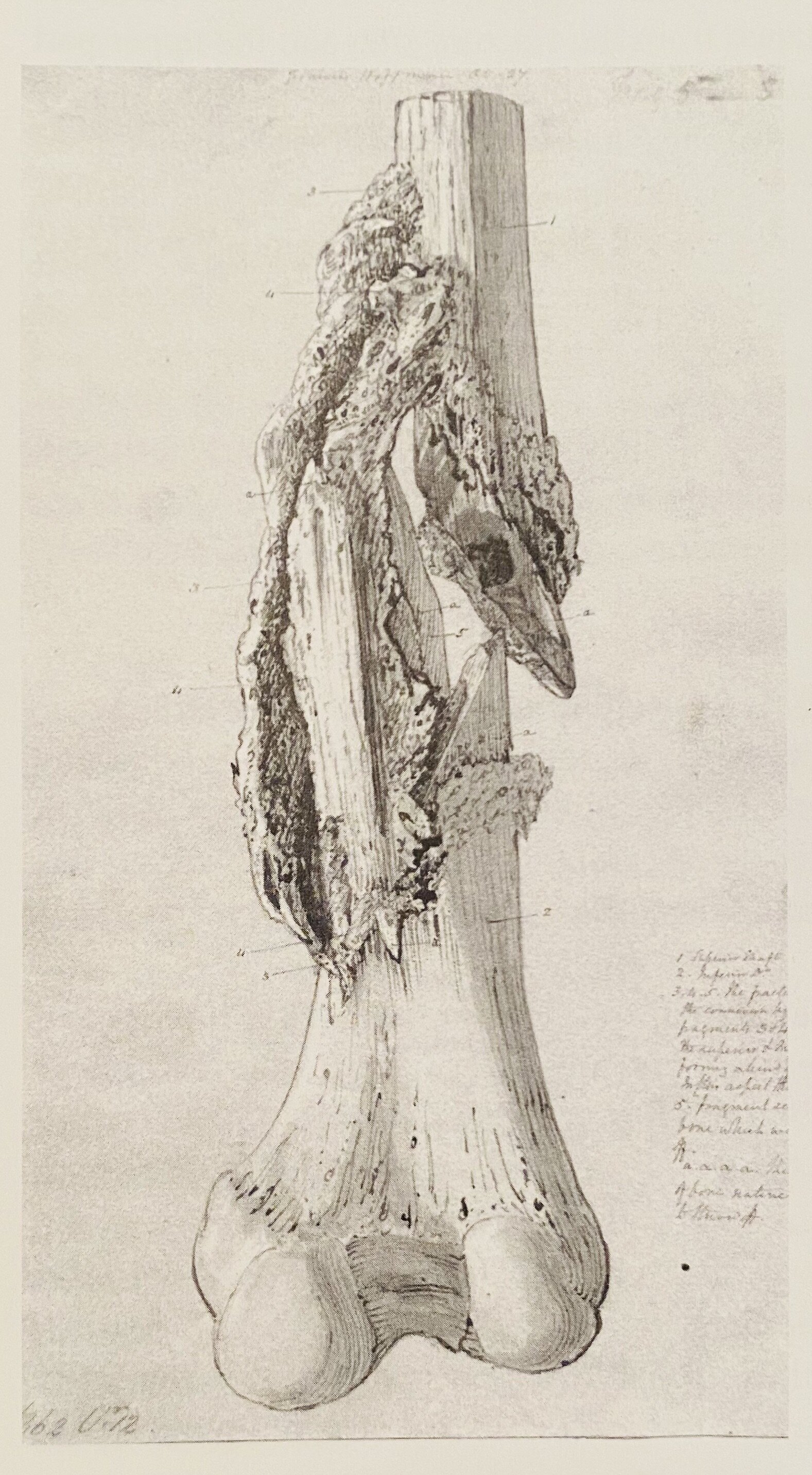 Fig. 8 Musketball fracture femur of Pvt Peter Purcell, Waterloo,