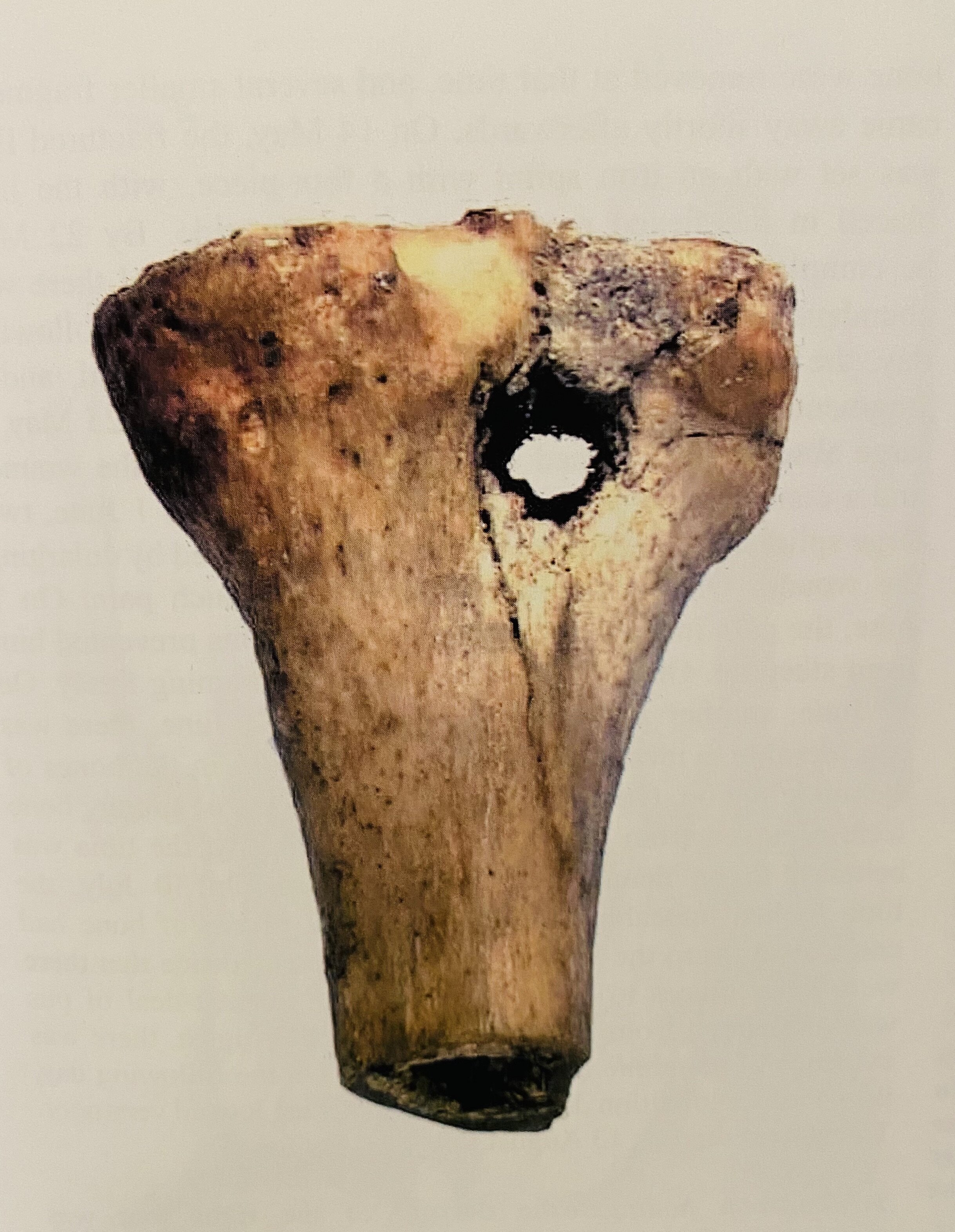 Fig.9 Musketball hole in tibia