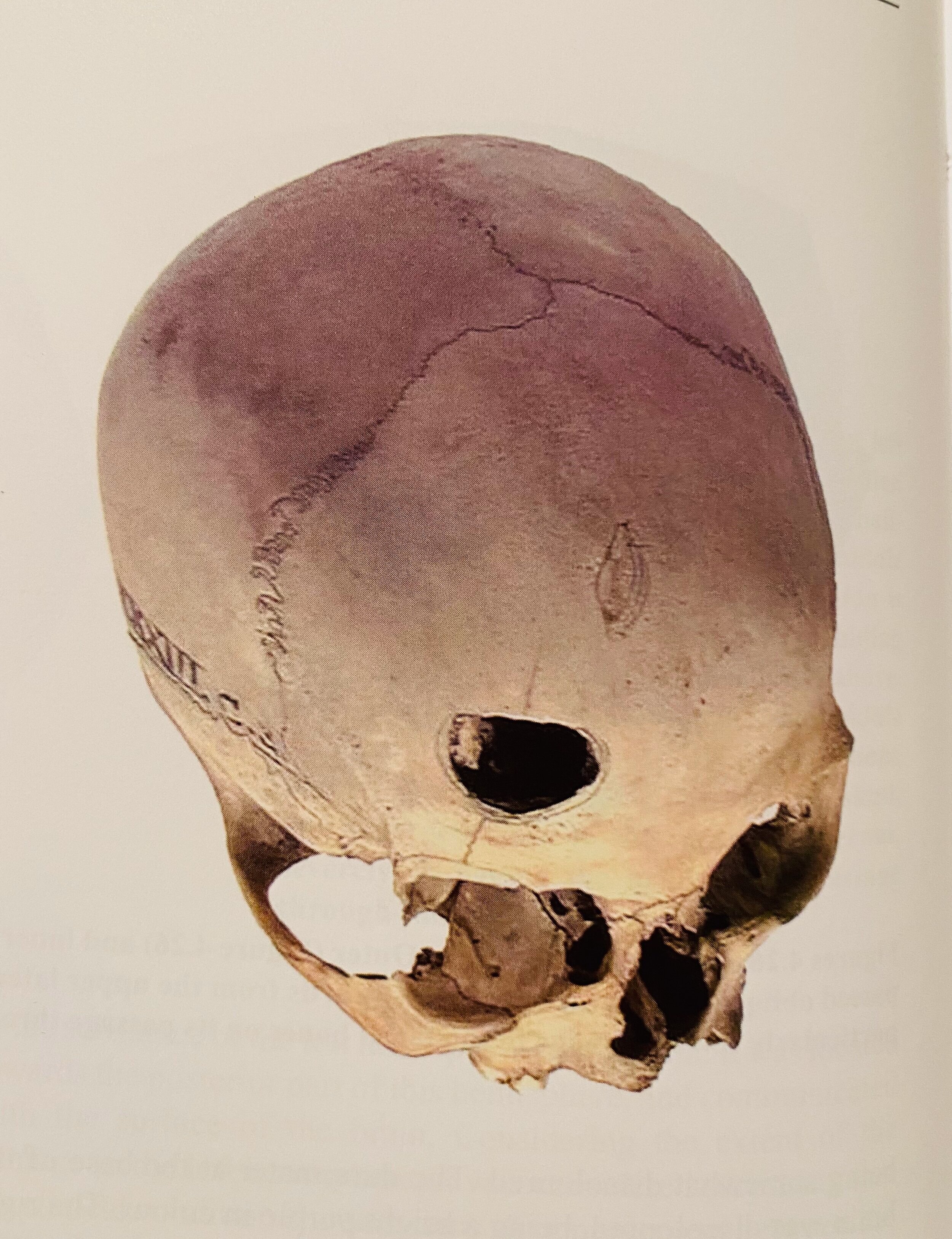 Fig 2. Musket-ball hole, Waterloo skull
