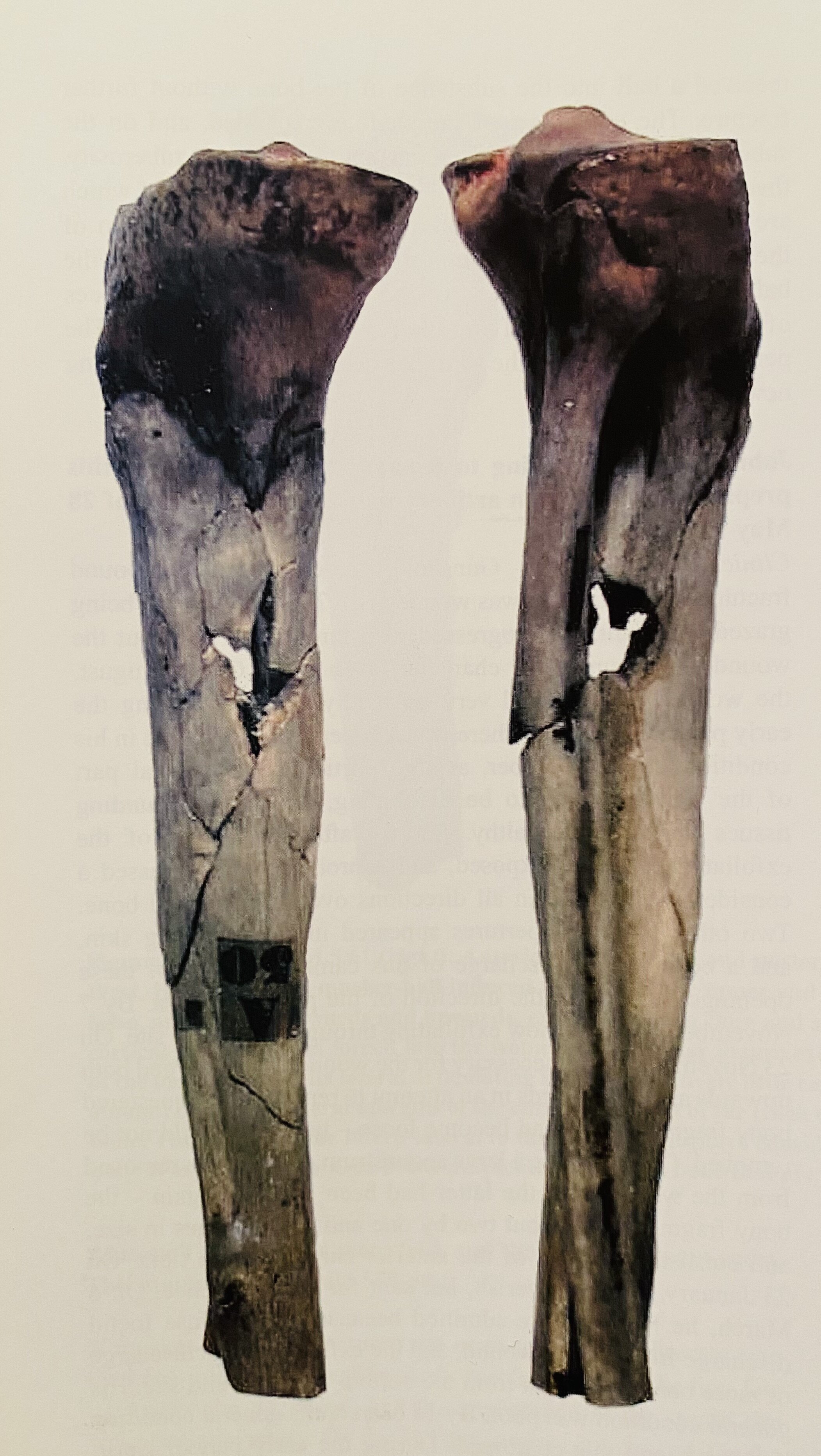 Fig.11 Musket-ball through tibia &amp; fibia