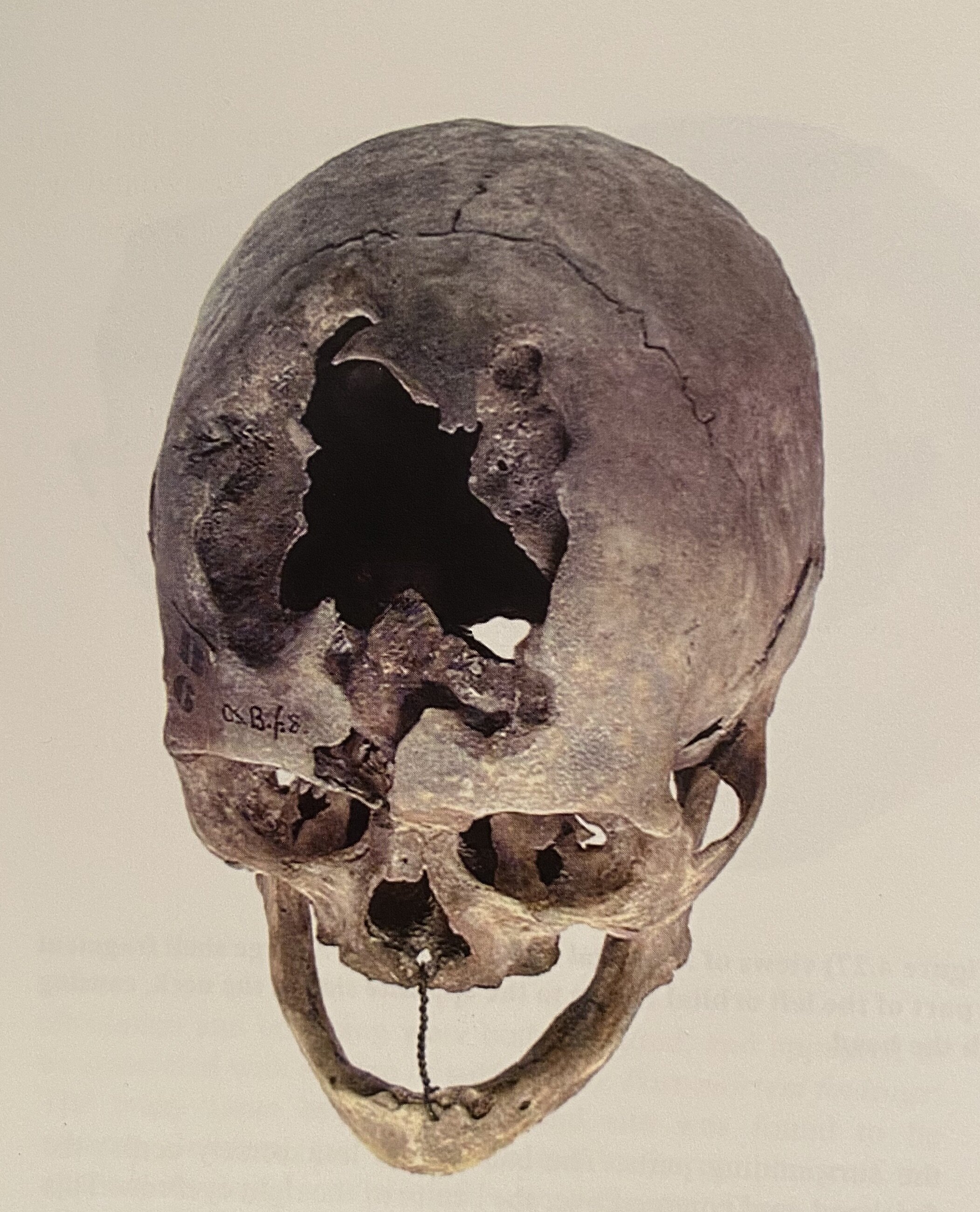 Fig. 1 -Gunshot wound to skull, Waterloo