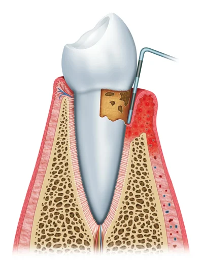 Periodontitis.jpg