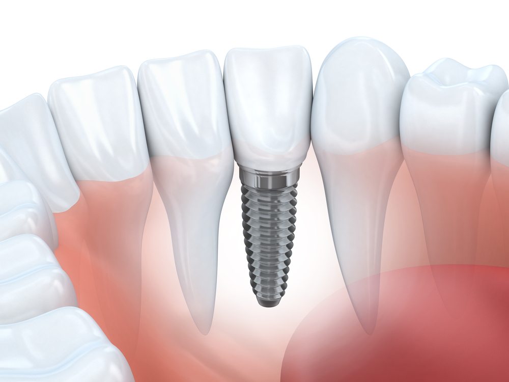 Denta-Implant.jpg