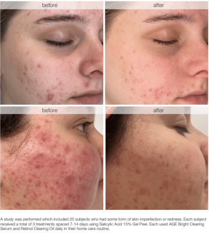 Dermalogica Salicylic Peel bliss albury.png
