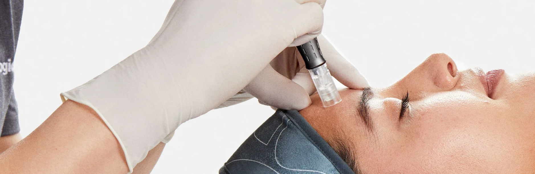 skin needling albury.png