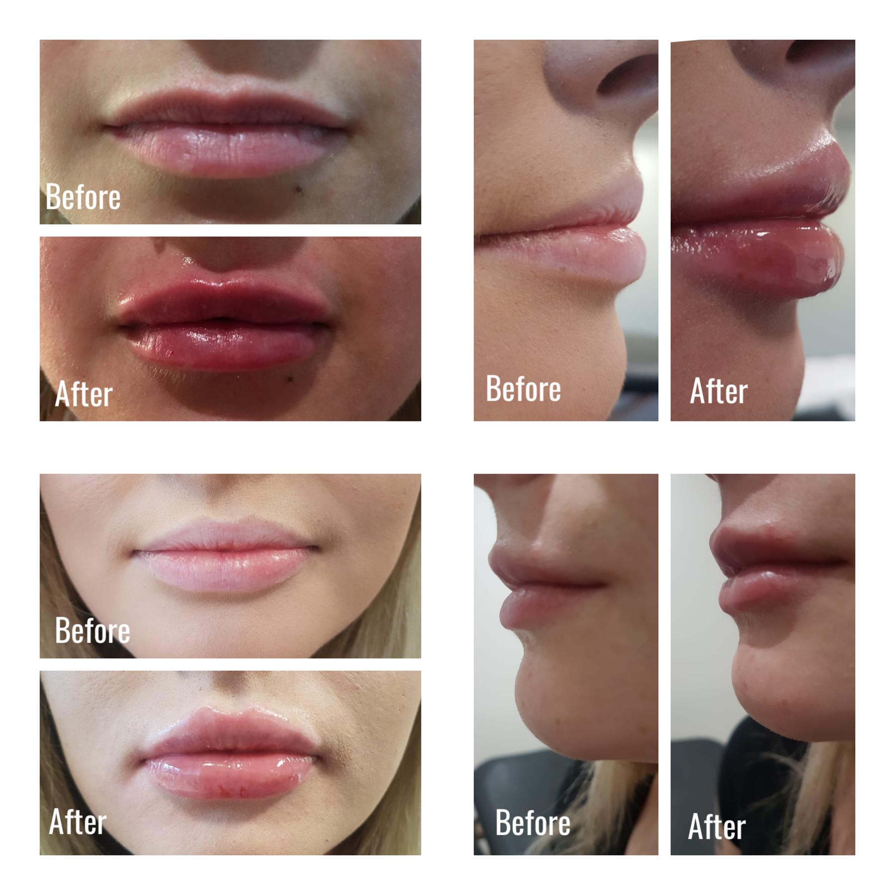 Different Lip Fillers : Hyaluronic Acid Fillers: Types, Cost, Uses ...