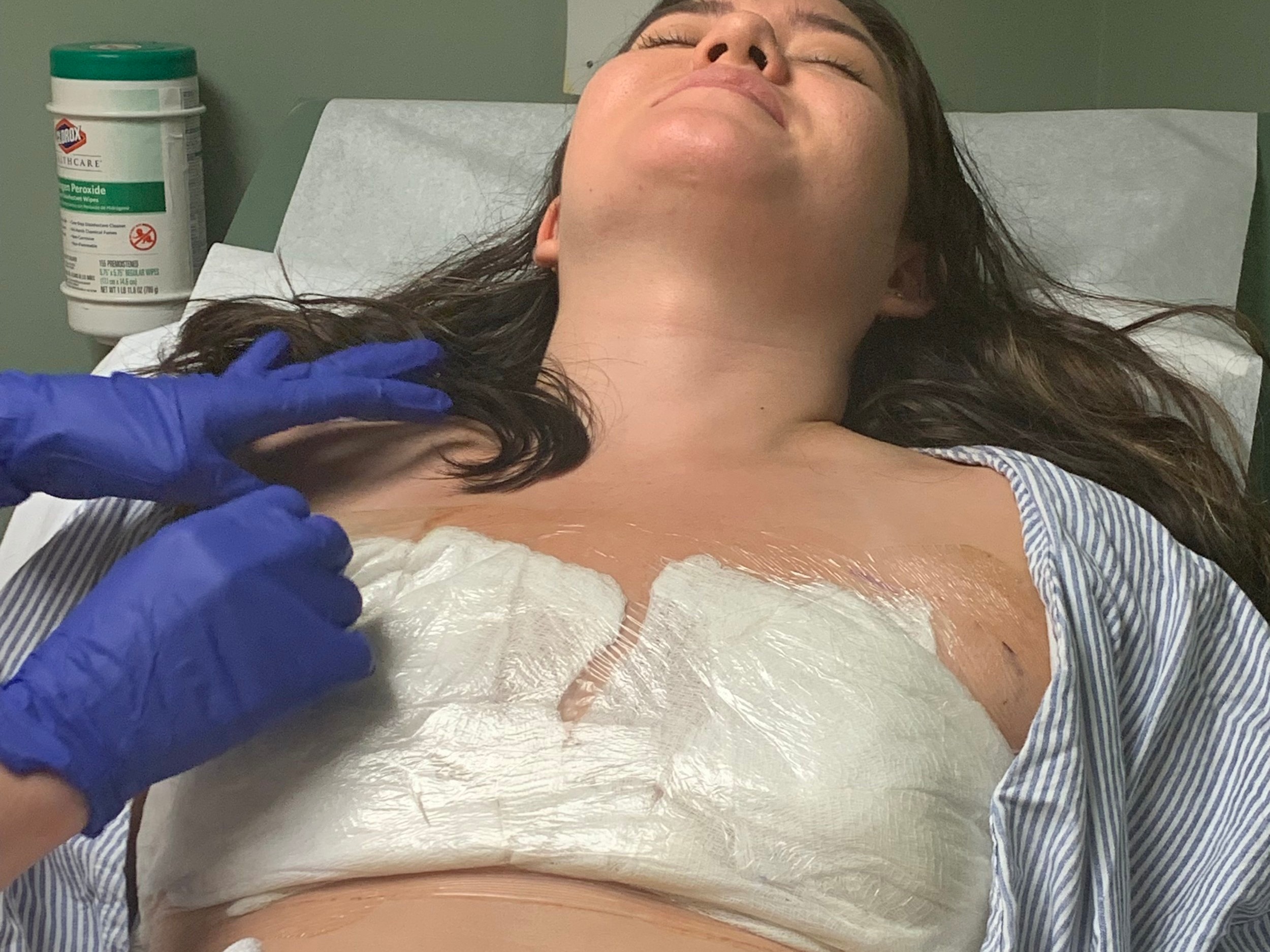 First post op, having a great time! The adhesive on that bandage was no joke people!!!