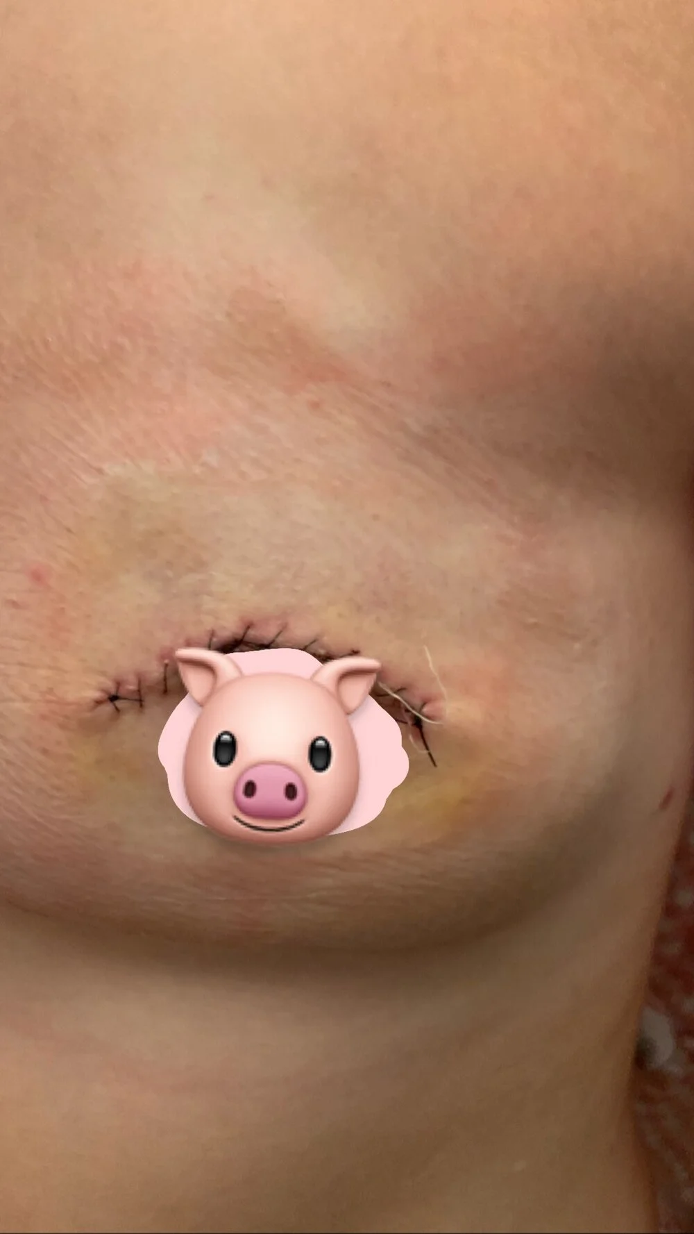 Sept 2019 / 8 weeks post-mastectomy / 80cc fill / 1 week post-debridement