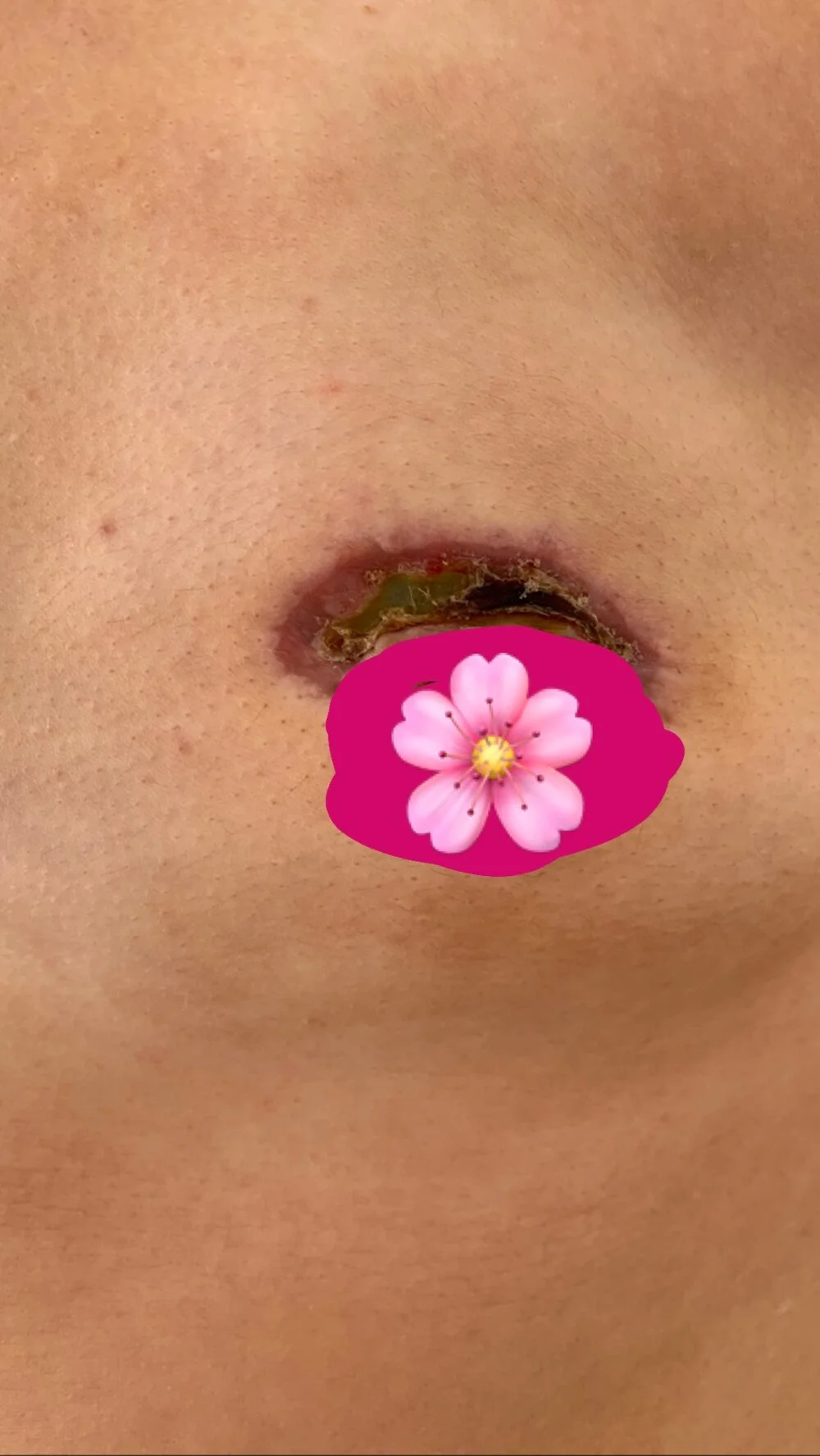 Aug 2019 / 6 weeks post-mastectomy / 50cc fill