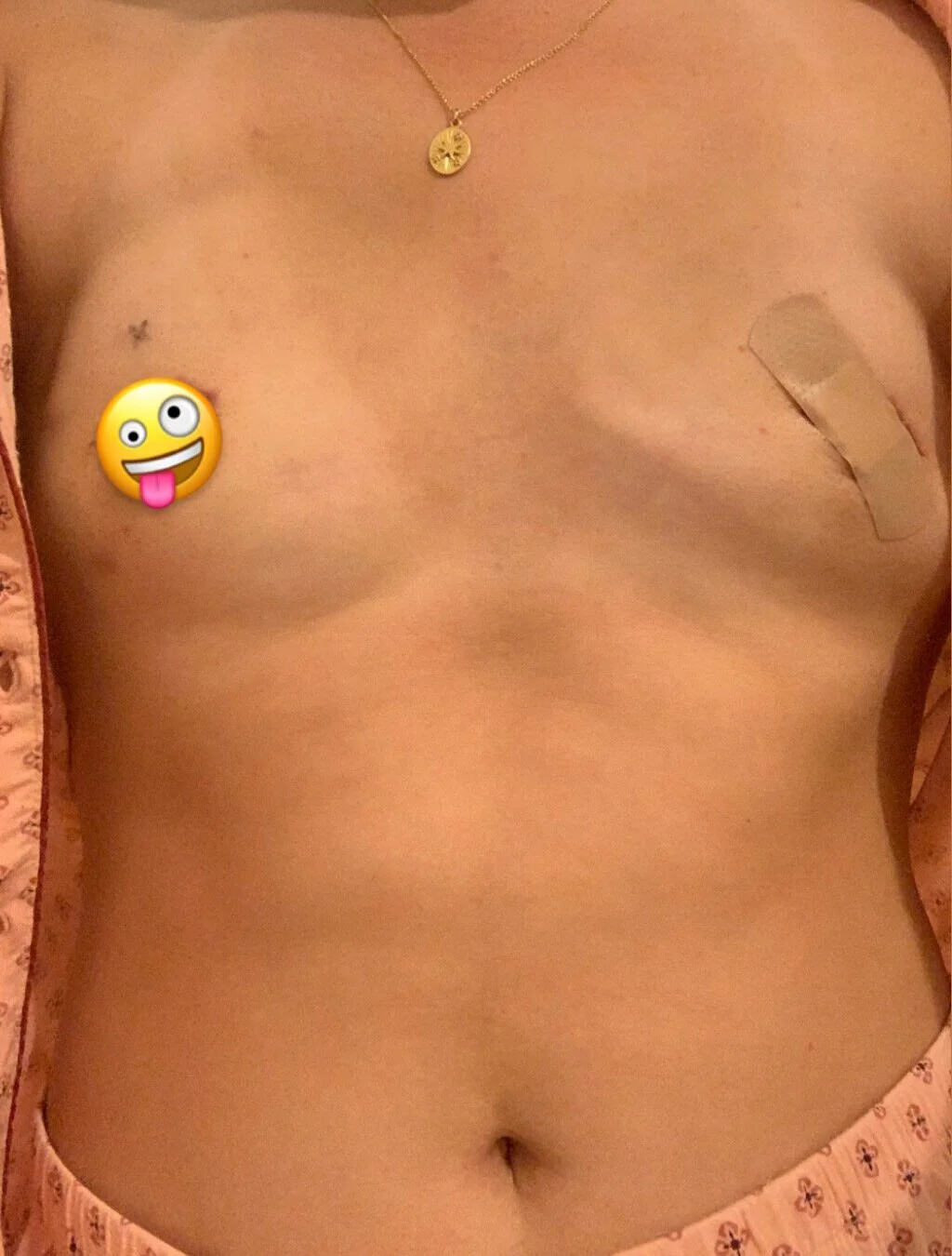 Right after my first baby fill. Since I couldn’t lift shirts on over my head for a couple months, this surgery was a good excuse to get some cute button up pajama sets