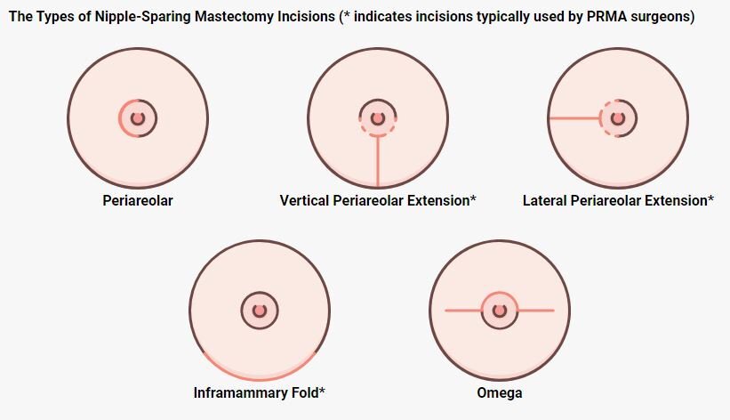 My first incisions were periareolar - like that top left picture but along the top instead of the side. My new incisions will be inframammary (bottom left).