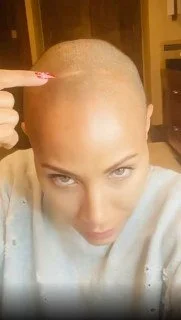 Biblical Alopecia