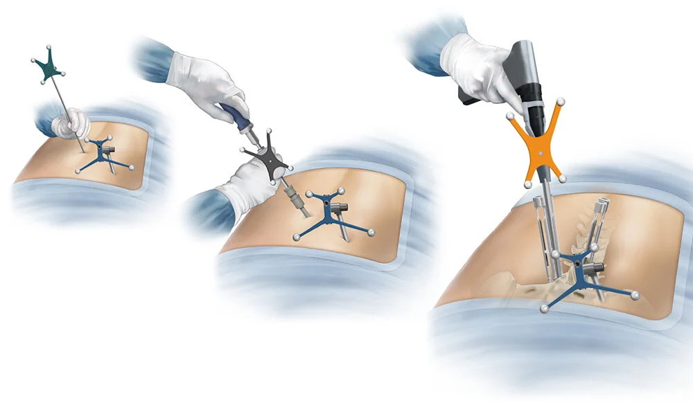 LOIF Prone Single Position Procedure 