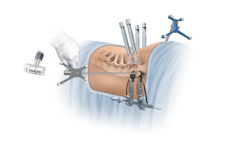 LOIF Prone Single Position Procedure 