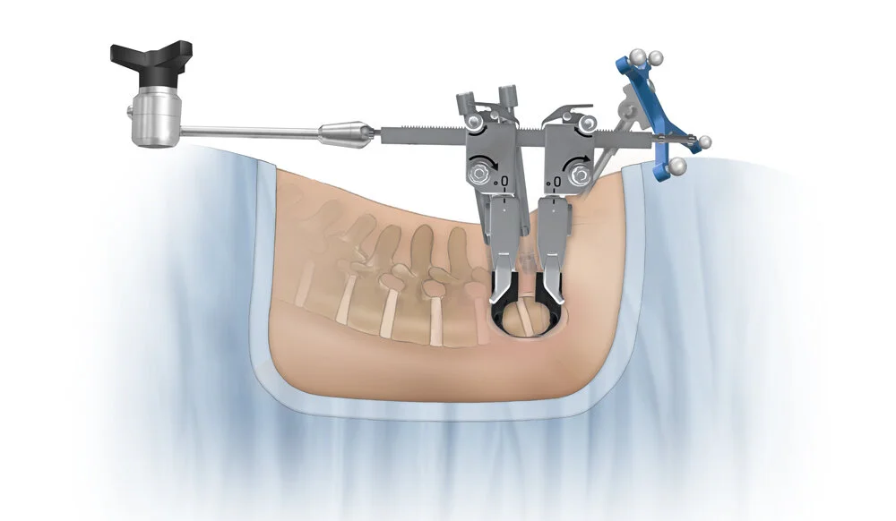 LOIF Prone Single Position Procedure 
