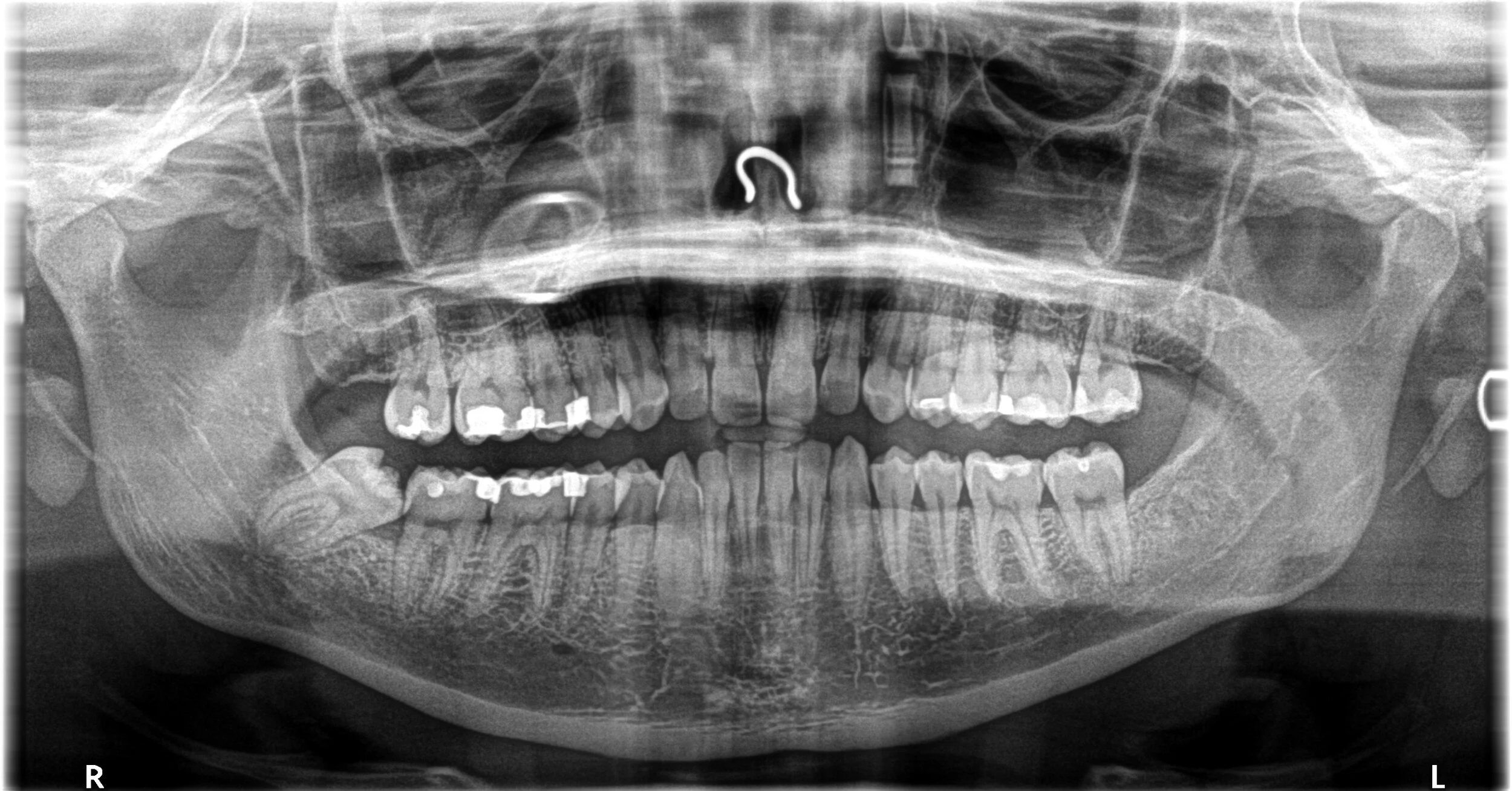 Loneliness and Isolation