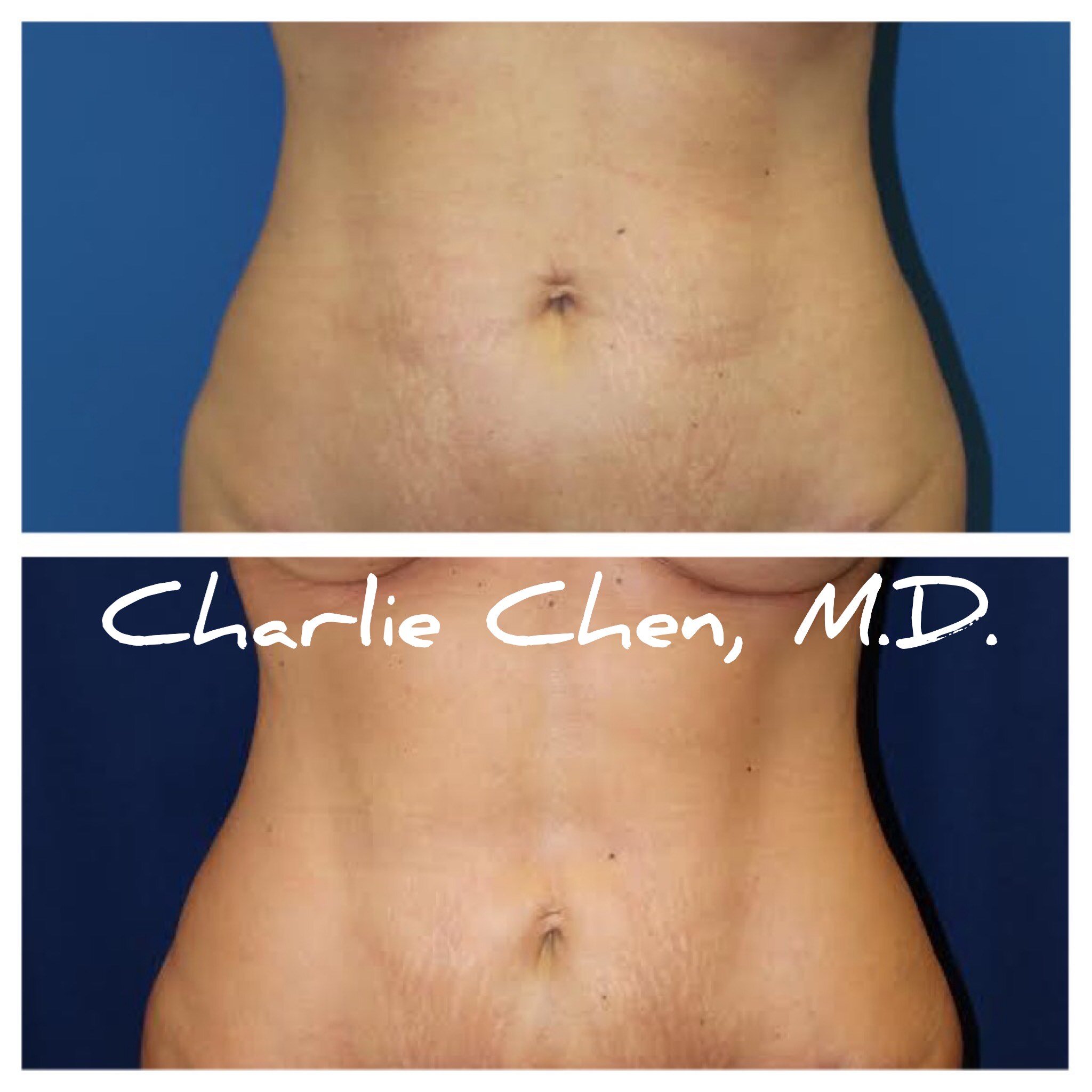 Abdominal Etching Before and After Photos, San Diego, CA - Charlie