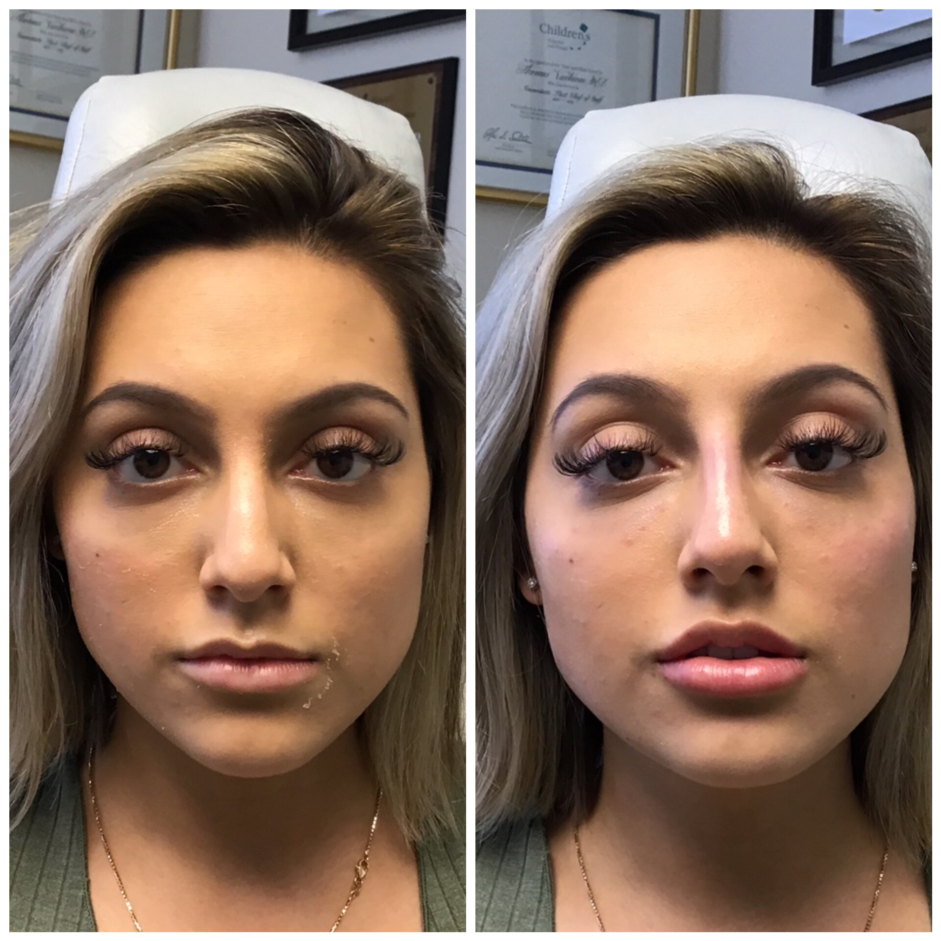 Botox and Fillers Before and After Photos, San Diego - Charlie Chen, MD  Plastic & Reconstructive Surgery