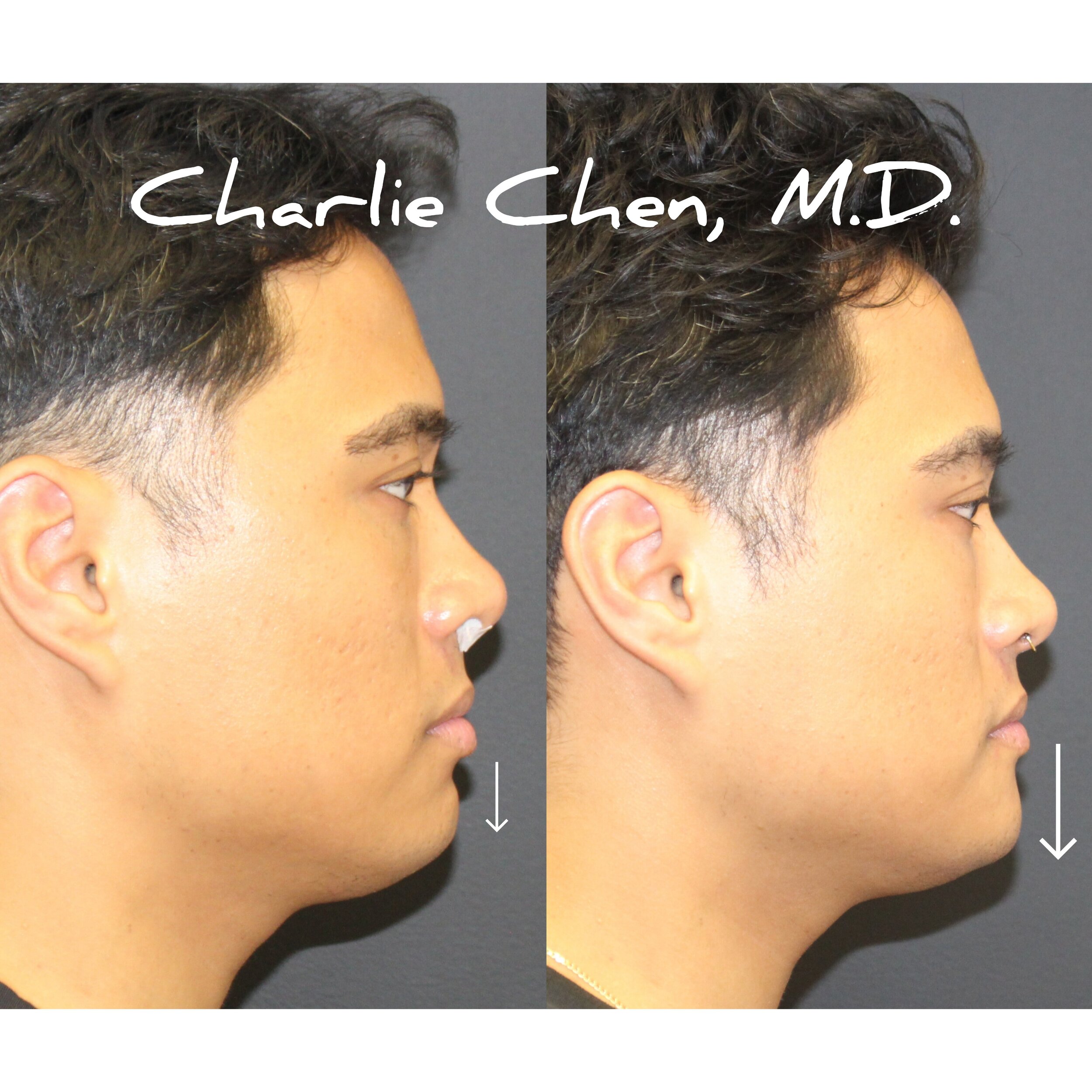 chin implant before and after