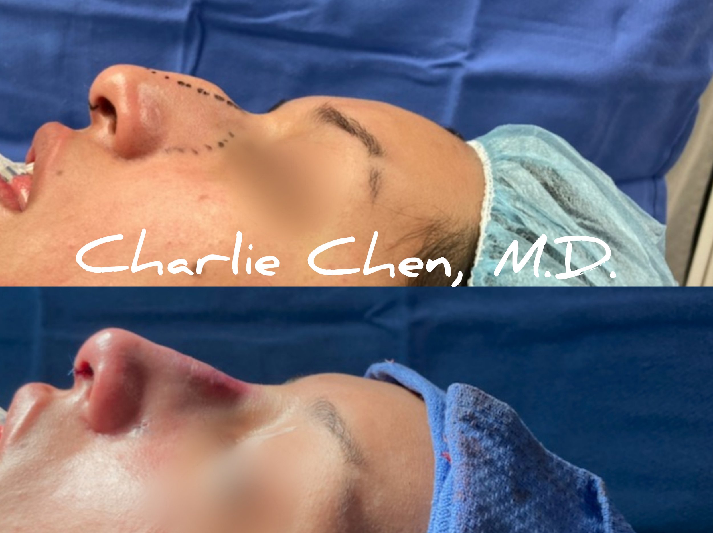 Bra-line Backlift, San Diego, CA - Charlie Chen, MD Plastic &  Reconstructive Surgery
