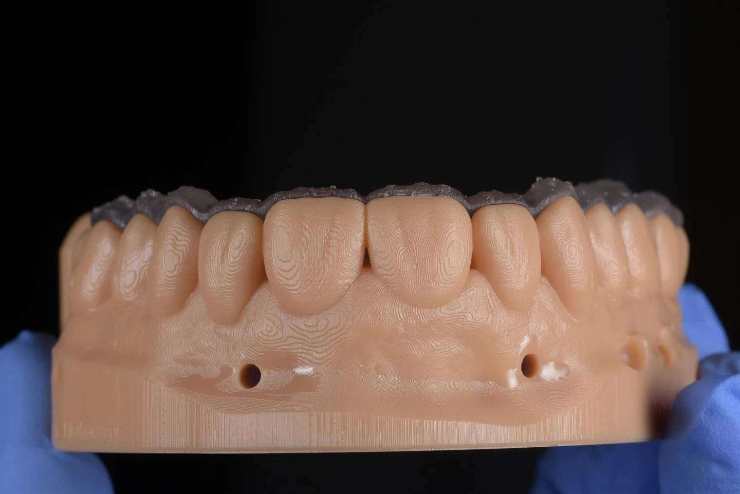 Prep guides. 
🔶As work becomes more and more digital why not close the loop and make the rest of the diagnostic phase digital.🔶 
🔷A buccal and incisal guide designed and printed in surgical material provides a rigid and accurate tool during prepar