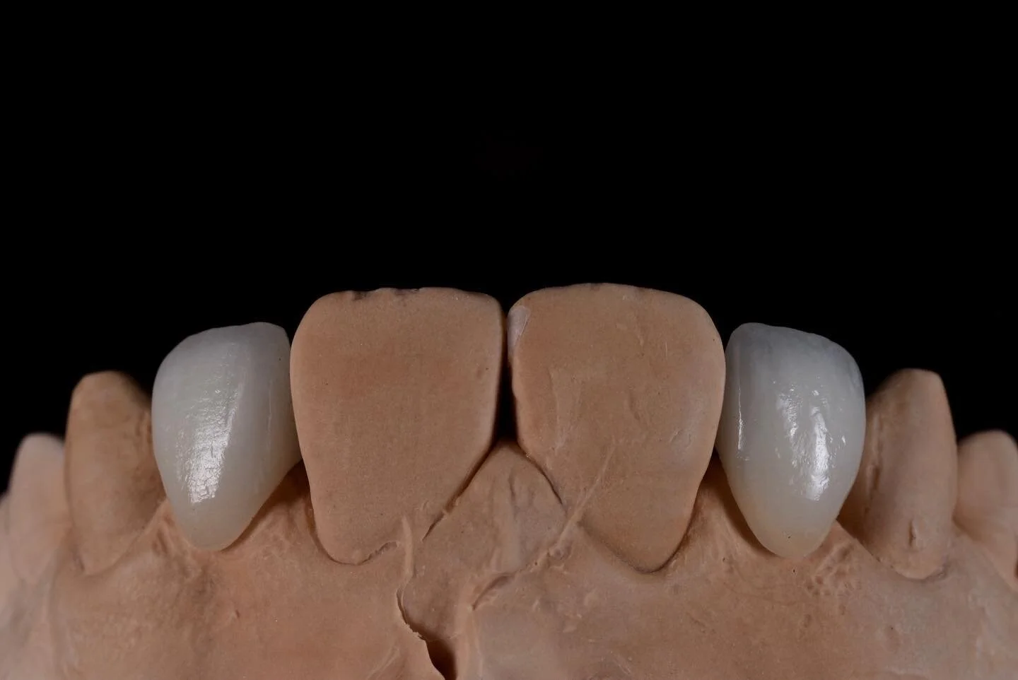 🔶Some lovely metal-ceramic Maryland bridges.🔶 
🔷Minimally invasive. Non-prep. Simple. 🔷
🔶Have a nice weekend everyone, stay safe!🔶
