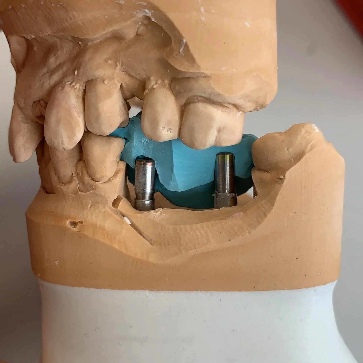 Great tip we like to give to our clients; using healing abutments to record the occlusion where there&rsquo;s no distal support. Fantastic way to verify the occlusion. 😬😬😬