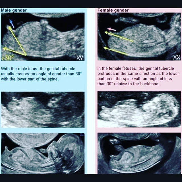 Early Gender Determination Ultrababy