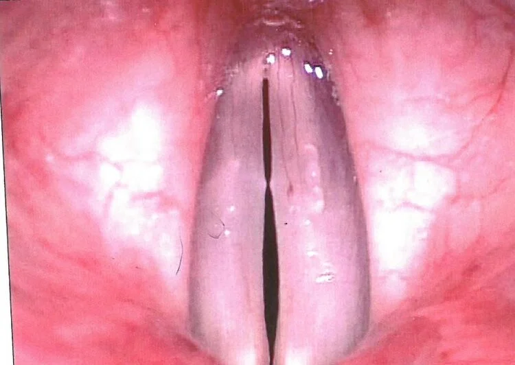 Typical appearance of vocal nodules. From Sataloff, R.T., Hawkshaw, M.J., Sataloff, J.B., DeFatta, R.A., and Eller, R.L. Atlas of Laryngoscopy, Third Edition. San Diego, California: Plural Publishing, Inc.; 2012.