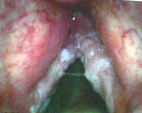 T1B squamous cell carcinoma (cancer) involving both vocal folds. From Sataloff, R.T., Hawkshaw, M.J., Sataloff, J.B., DeFatta, R.A., and Eller, R.L. Atlas of Laryngoscopy, Third Edition. San Diego, California: Plural Publishing, Inc.; 2012.
