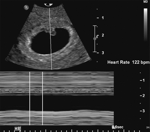 Ultrasound Series: Part 3 Heartbeat — Crossroads Pregnancy Center