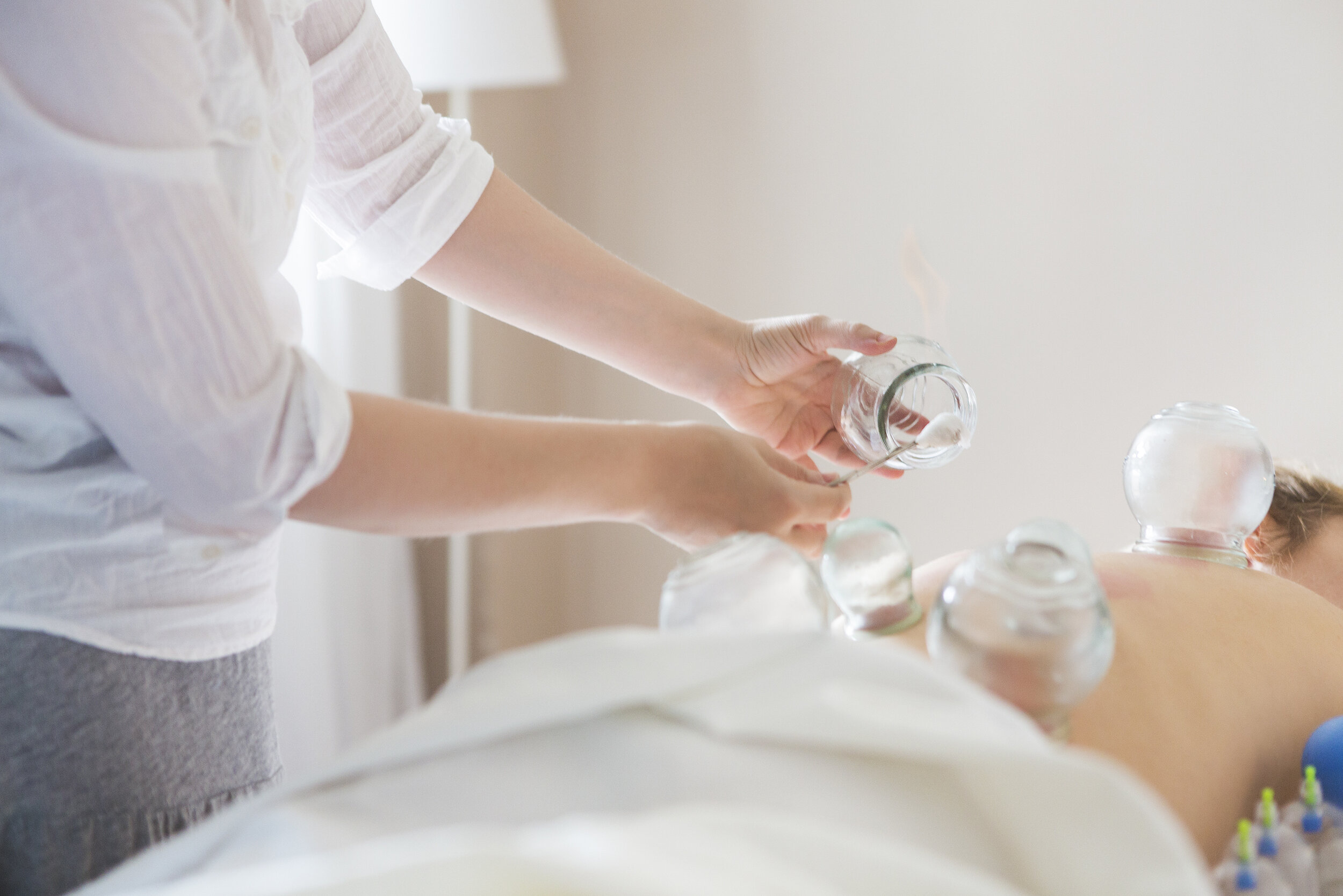 Cupping Therapy — AcuPremier Acupuncture