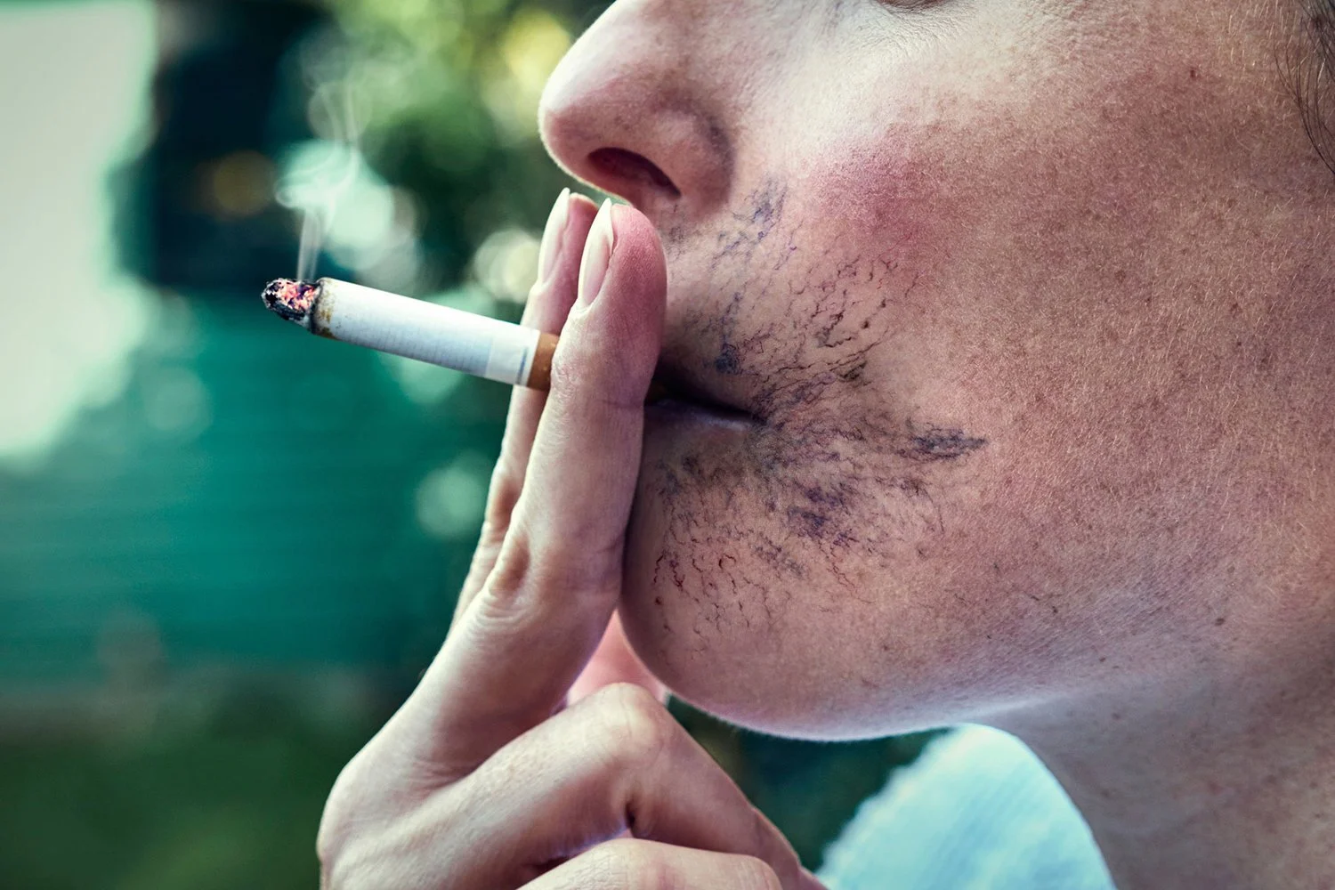 Close-up of a person smoking a cigarette outdoors, with visible facial scars and textured skin.