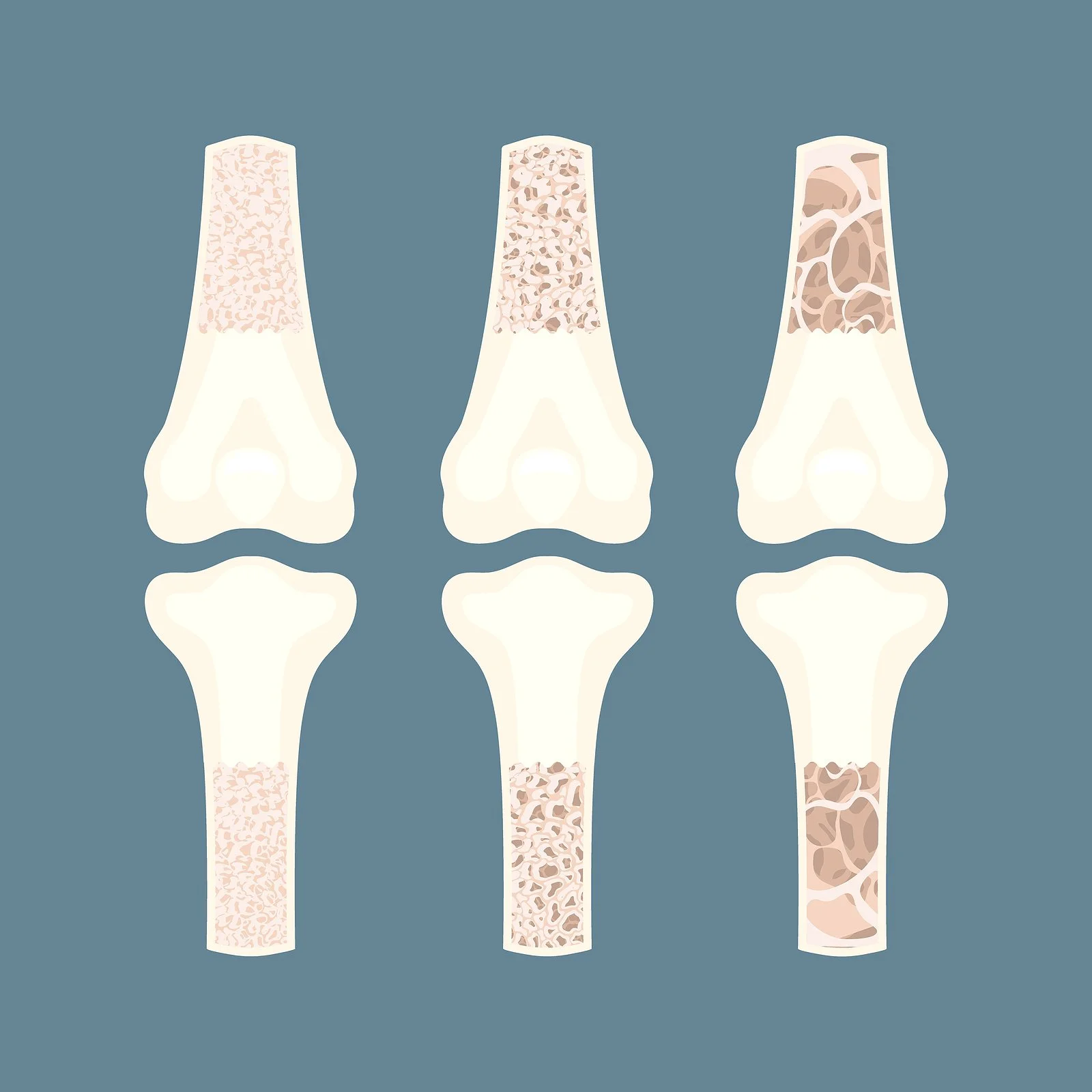Help Your Parents Keep Their Bones Strong As They Age